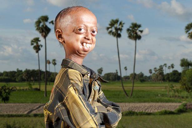अली हुसैन खान – यह एक 14 साल का भारतीय बचा है जो एक विचित्र बीमारी progeria से पीड़ित है। जिस से यह उम्र से पहले ही बूढा दिख रहा है। 