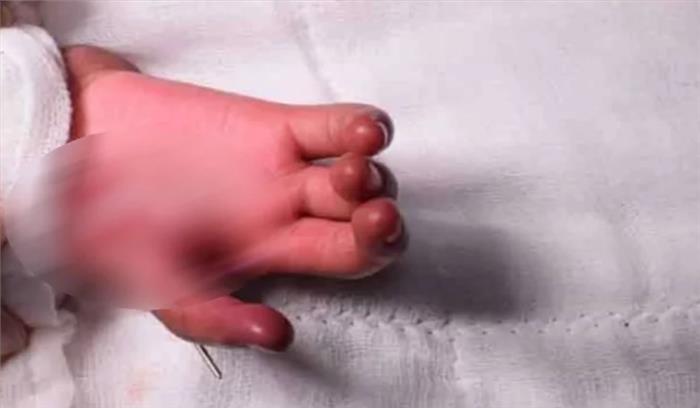 एम्स ऋषिकेश के डॉक्टरों ने की अनोखी सर्जरी , हाथ की अंगुली को बना दिया अंगूठा