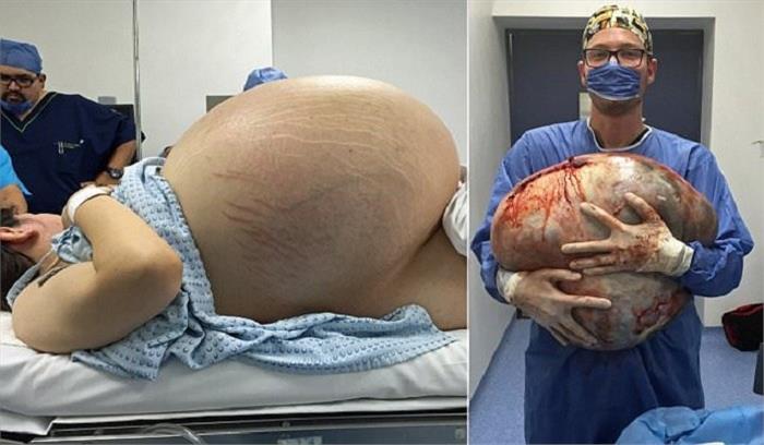 दिखने में लग रही थी गर्भवती, डॉक्टरों ने जब किया आॅपरेशन, तो उड़ गए होश
